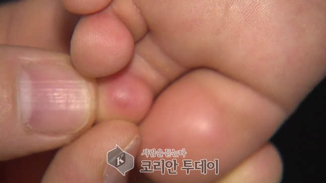 개인위생 신경써야….수족구병 증가세
