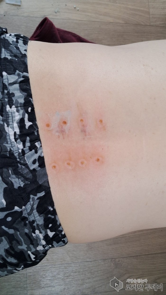 [Korean Today] A patient with a herniated disc in the 4th and 5th vertebrae appears after moxibustion © Reporter Park Chan-doo