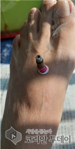 I Win with Moxibustion: Treat Herniated Disc without Surgery, Use Moxibustion Instea