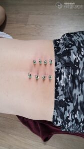 I Win with Moxibustion: Treat Herniated Disc without Surgery, Use Moxibustion Instea