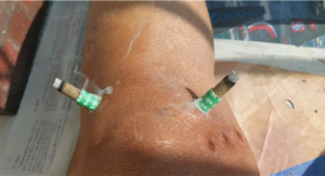I Bet on Moxibustion: Relieve Knee Pain Without Surgery