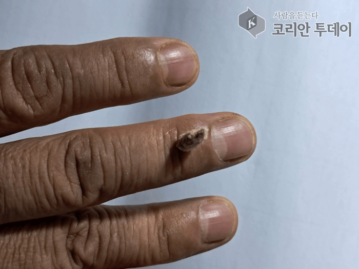 [코리안투데이] 손가락 마디에 쑥씀 올려놓은 모습 ⓒ 박찬두 기자
