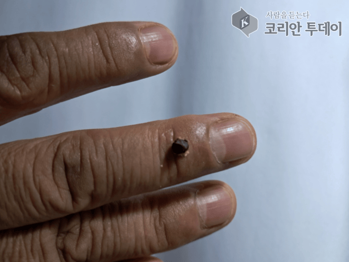 [코리안투데이] 손가락 마디에서 쑥뜸이 다 탄 모습 ⓒ 박찬두 기자