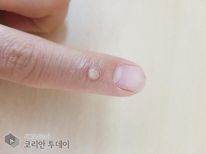 [Korean Today] Appearance of a corn on the finger joint (Photo provided by Zoomarella) ⓒ Reporter Park Chan-doo