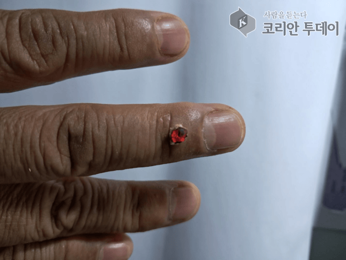 [Korean Today] Moxibustion burning on the finger joint ⓒ Reporter Park Chan-doo