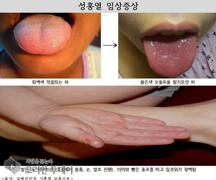 [코리안투데이] 성홍열 교육자료 © 김미희 기자