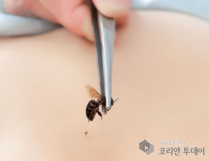[코리안투데이] 자가 봉침 및 한의원에서 벌침 놓는 모습 © 최도선 칼럼리스트