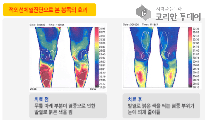 [코리안투데이] 적외선체열진단기로 본 봉침 전후 염증 감소상태 모습 © 자생한방병원 제공