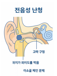 난청의 종류와 분류